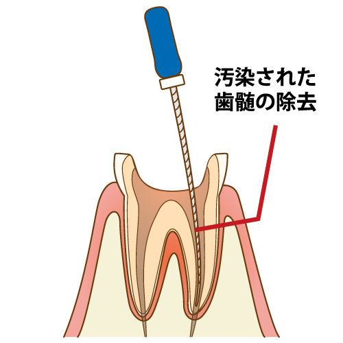感染した歯髄の除去