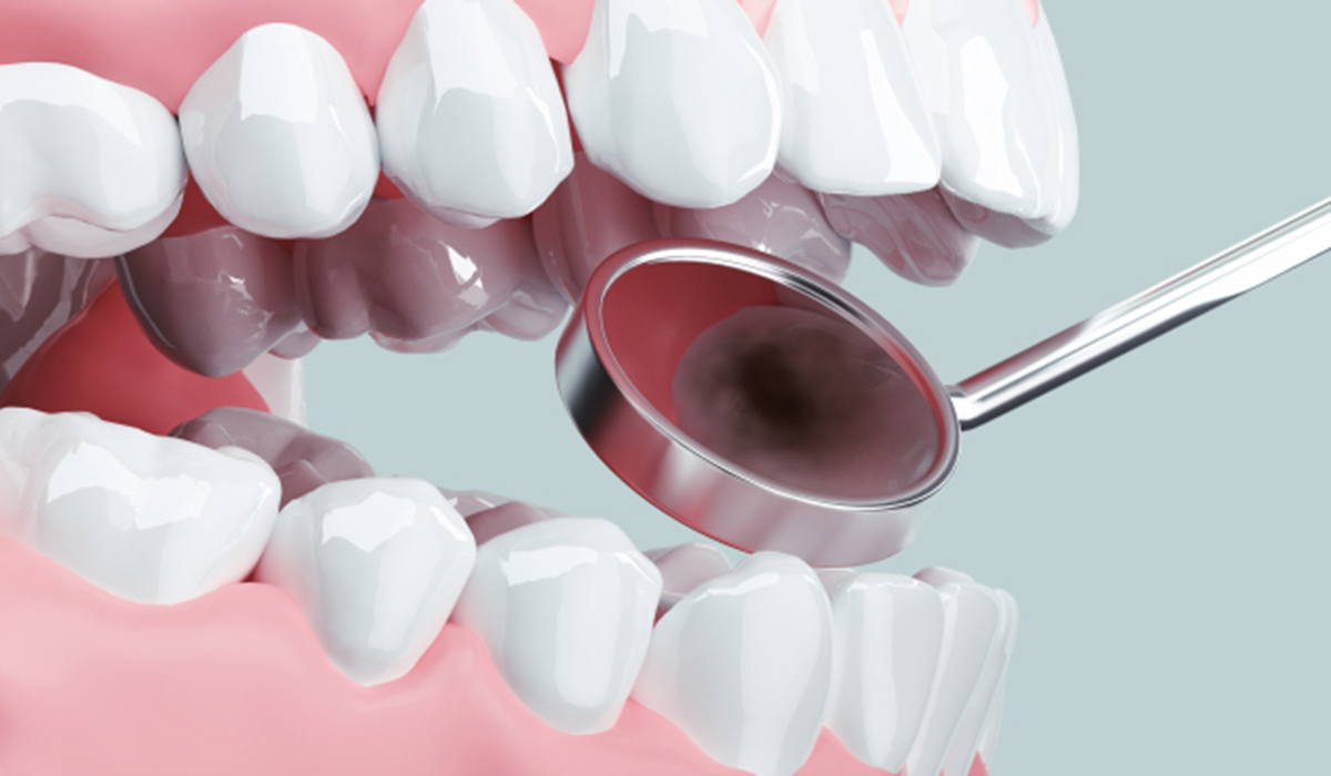 治療した歯の方が虫歯リスクは高い